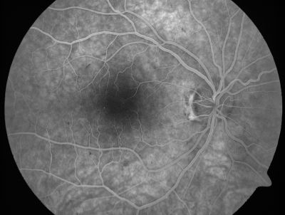 Retinal Vasculopathy associated with Facioscapulohumeral Muscular Dystrophy early fa
59-year-old woman had a blood pressure spike to 170/90 and was on medications for that. She does have facioscapulohumeral muscular dystrophy, which runs in her family. She has a cousin with the same disorder.
VISUAL ACUITY: Her vision is 20/25 OU. IOP: OD 21, OS 18.
There is no posterior vitreous separation, telangiectatic vessels near the macula. There are patchy retinal hemorrhages. There is no edema or proliferation.

Keywords: diabetic like; systemic disease; vasculopathy; hemorrhage; bdr