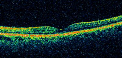 Retinal Vasculopathy associated with Facioscapulohumeral Muscular Dystrophy  OCT right eye line scan
59-year-old woman had a blood pressure spike to 170/90 and was on medications for that. She does have facioscapulohumeral muscular dystrophy, which runs in her family. She has a cousin with the same disorder.
VISUAL ACUITY: Her vision is 20/25 OU. IOP: OD 21, OS 18.
There is no posterior vitreous separation, telangiectatic vessels near the macula. There are patchy retinal hemorrhages. There is no edema or proliferation.

Keywords: diabetic like; systemic disease; vasculopathy; hemorrhage; bdr