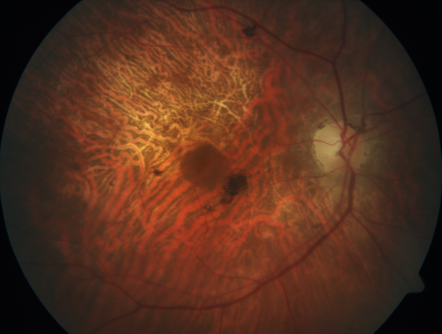 Concentric Geographic Atrophy - 76 year old man
Gradual vision loss, worse at night.  VA 20/40 OU.
