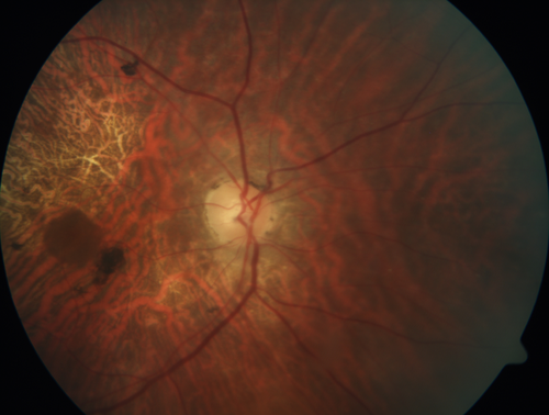 Concentric Geographic Atrophy - 76 year old man
Gradual vision loss, worse at night.  VA 20/40 OU.
