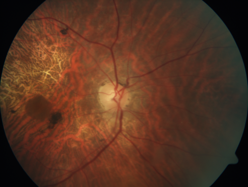Concentric Geographic Atrophy
76 year old man Gradual vision loss
20/32 OD; 20/40 OS
No medicines, Non-smoker
Working and Driving
