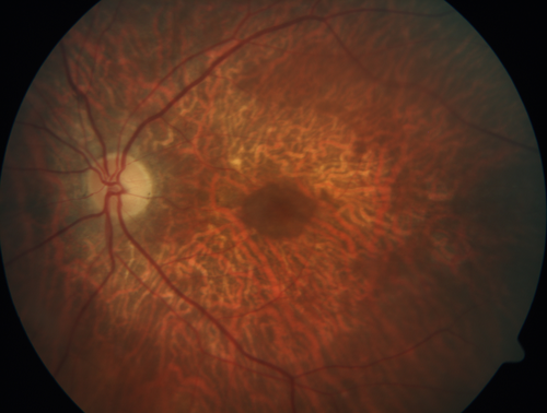 Concentric Geographic Atrophy - 76 year old man
Gradual vision loss, worse at night.  VA 20/40 OU.

