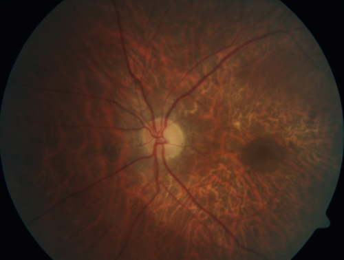 Concentric Geographic Atrophy - 76 year old man
Gradual vision loss, worse at night.  VA 20/40 OU.
