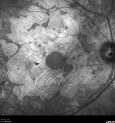 Concentric Geographic Atrophy
76 year old man Gradual vision loss
20/32 OD; 20/40 OS
No medicines, Non-smoker
Working and Driving
