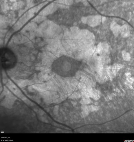 Concentric Geographic Atrophy - 76 year old man
Gradual vision loss, worse at night.  VA 20/40 OU.
