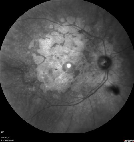 Concentric Geographic Atrophy - 76 year old man
Gradual vision loss, worse at night.  VA 20/40 OU.

