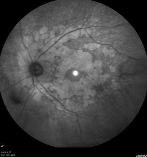 Concentric Geographic Atrophy
76 year old man Gradual vision loss
20/32 OD; 20/40 OS
No medicines, Non-smoker
Working and Driving
