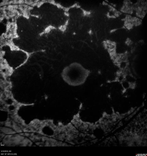 Concentric Geographic Atrophy - 76 year old man
Gradual vision loss, worse at night.  VA 20/40 OU.
