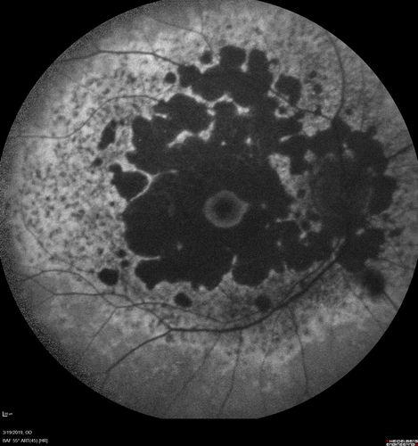 Concentric Geographic Atrophy
76 year old man Gradual vision loss
20/32 OD; 20/40 OS
No medicines, Non-smoker
Working and Driving
