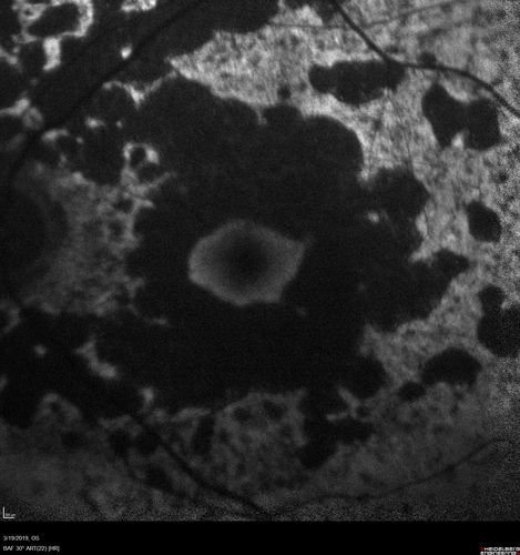 Concentric Geographic Atrophy
76 year old man Gradual vision loss
20/32 OD; 20/40 OS
No medicines, Non-smoker
Working and Driving
