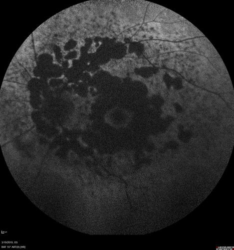Concentric Geographic Atrophy
76 year old man Gradual vision loss
20/32 OD; 20/40 OS
No medicines, Non-smoker
Working and Driving

