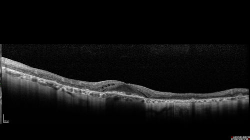 Concentric Geographic Atrophy - 76 year old man
Gradual vision loss, worse at night.  VA 20/40 OU.
