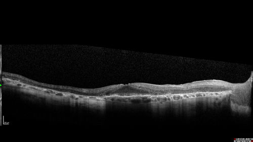 Concentric Geographic Atrophy - 76 year old man
Gradual vision loss, worse at night.  VA 20/40 OU.
