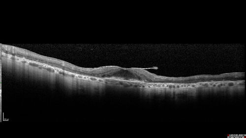 Concentric Geographic Atrophy
76 year old man Gradual vision loss
20/32 OD; 20/40 OS
No medicines, Non-smoker
Working and Driving
