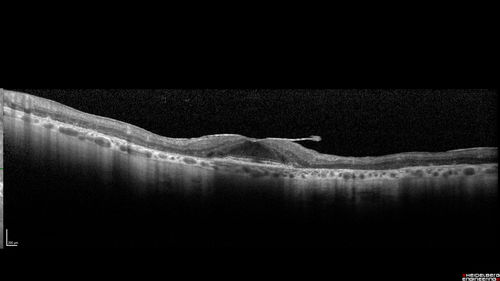 Concentric Geographic Atrophy - 76 year old man
Gradual vision loss, worse at night.  VA 20/40 OU.
