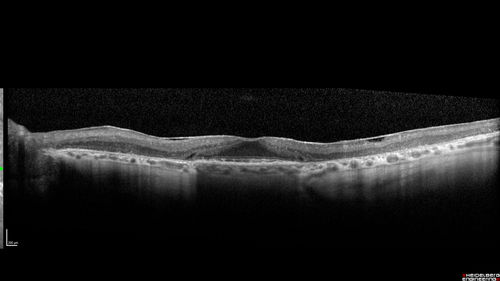 Concentric Geographic Atrophy - 76 year old man
Gradual vision loss, worse at night.  VA 20/40 OU.

