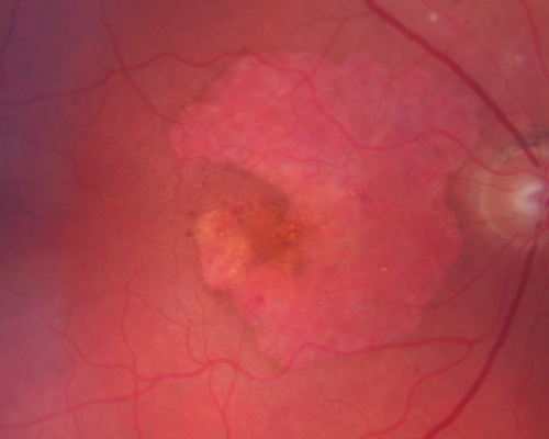 Geographic Atrophy and Age-Related Macular Degeneration - Choriocapillaris is Largely Still Intact
85-year-old woman has age-related macular degeneration in both eyes with geographic atrophy.  She has noticed her vision getting slightly worse in the past 6 months. VISUAL ACUITY:  OD 20/70, OS 20/400
