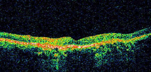 Geographic Atrophy and Age-Related Macular Degeneration - Choriocapillaris is Largely Still Intact
85-year-old woman has age-related macular degeneration in both eyes with geographic atrophy.  She has noticed her vision getting slightly worse in the past 6 months. VISUAL ACUITY:  OD 20/70, OS 20/400
