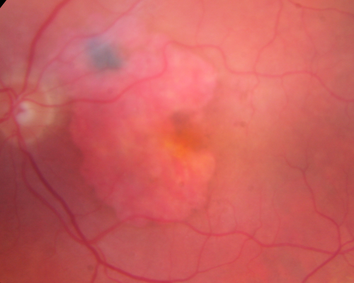 Geographic Atrophy and Age-Related Macular Degeneration - Choriocapillaris is Largely Still Intact
85-year-old woman has age-related macular degeneration in both eyes with geographic atrophy.  She has noticed her vision getting slightly worse in the past 6 months. VISUAL ACUITY:  OD 20/70, OS 20/400
