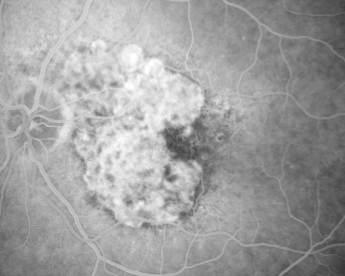 Geographic Atrophy and Age-Related Macular Degeneration - Choriocapillaris is Largely Still Intact
85-year-old woman has age-related macular degeneration in both eyes with geographic atrophy.  She has noticed her vision getting slightly worse in the past 6 months. VISUAL ACUITY:  OD 20/70, OS 20/400
