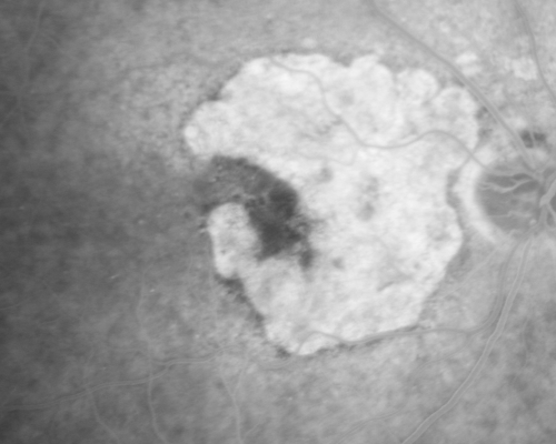 Geographic Atrophy and Age-Related Macular Degeneration - Choriocapillaris is Largely Still Intact
85-year-old woman has age-related macular degeneration in both eyes with geographic atrophy.  She has noticed her vision getting slightly worse in the past 6 months. VISUAL ACUITY:  OD 20/70, OS 20/400
