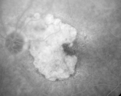 Geographic Atrophy and Age-Related Macular Degeneration - Choriocapillaris is Largely Still Intact
85-year-old woman has age-related macular degeneration in both eyes with geographic atrophy.  She has noticed her vision getting slightly worse in the past 6 months. VISUAL ACUITY:  OD 20/70, OS 20/400
