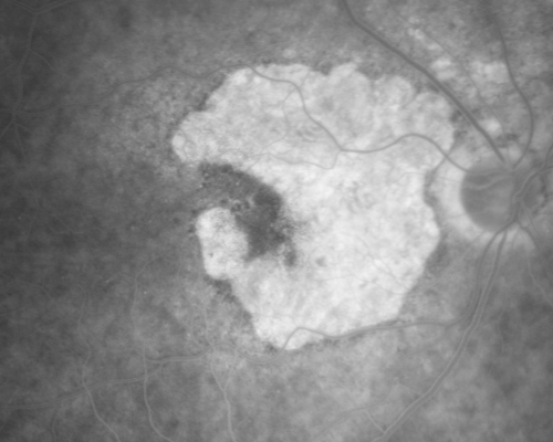 Geographic Atrophy and Age-Related Macular Degeneration - Choriocapillaris is Largely Still Intact
85-year-old woman has age-related macular degeneration in both eyes with geographic atrophy.  She has noticed her vision getting slightly worse in the past 6 months. VISUAL ACUITY:  OD 20/70, OS 20/400
