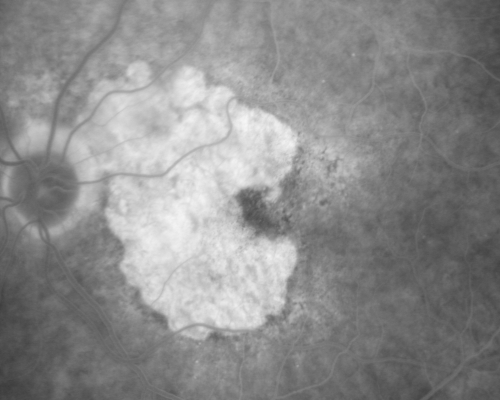 Geographic Atrophy and Age-Related Macular Degeneration - Choriocapillaris is Largely Still Intact
85-year-old woman has age-related macular degeneration in both eyes with geographic atrophy.  She has noticed her vision getting slightly worse in the past 6 months. VISUAL ACUITY:  OD 20/70, OS 20/400

