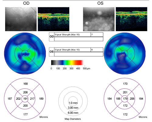 Geographic Atrophy and Age-Related Macular Degeneration - Choriocapillaris is Largely Still Intact
85-year-old woman has age-related macular degeneration in both eyes with geographic atrophy.  She has noticed her vision getting slightly worse in the past 6 months. VISUAL ACUITY:  OD 20/70, OS 20/400
