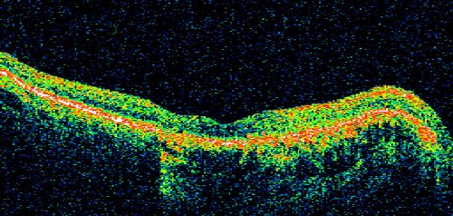Geographic Atrophy and Age-Related Macular Degeneration - Choriocapillaris is Largely Still Intact
85-year-old woman has age-related macular degeneration in both eyes with geographic atrophy.  She has noticed her vision getting slightly worse in the past 6 months. VISUAL ACUITY:  OD 20/70, OS 20/400
