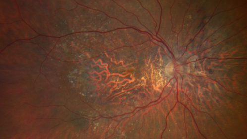 Severe Geographic Atrophy from Dry Age-Related Macular Degeneration
90 year old female with severe vision loss over the last few years.  
VA 3/200 OD
1/200 OS
