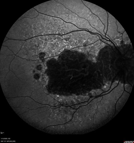 Severe Geographic Atrophy from Dry Age-Related Macular Degeneration
90 year old female with severe vision loss over the last few years.  
VA 3/200 OD
1/200 OS
