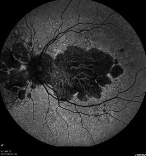 Severe Geographic Atrophy from Dry Age-Related Macular Degeneration
90 year old female with severe vision loss over the last few years.  
VA 3/200 OD
1/200 OS

