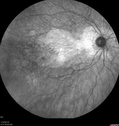 Severe Geographic Atrophy from Dry Age-Related Macular Degeneration
90 year old female with severe vision loss over the last few years.  
VA 3/200 OD
1/200 OS
