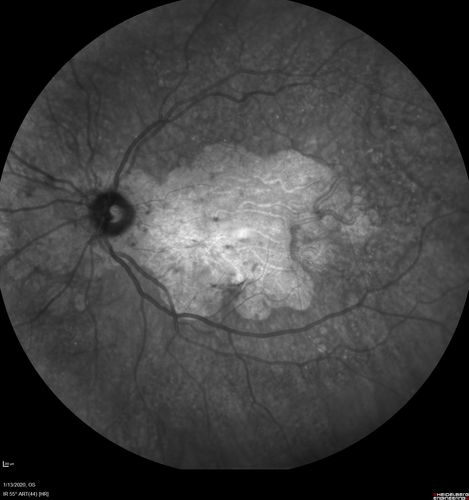 Severe Geographic Atrophy from Dry Age-Related Macular Degeneration
90 year old female with severe vision loss over the last few years.  
VA 3/200 OD
1/200 OS
