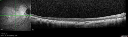 Severe Geographic Atrophy from Dry Age-Related Macular Degeneration
90 year old female with severe vision loss over the last few years.  
VA 3/200 OD
1/200 OS

