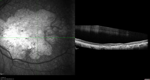 Severe Geographic Atrophy from Dry Age-Related Macular Degeneration
90 year old female with severe vision loss over the last few years.  
VA 3/200 OD
1/200 OS
