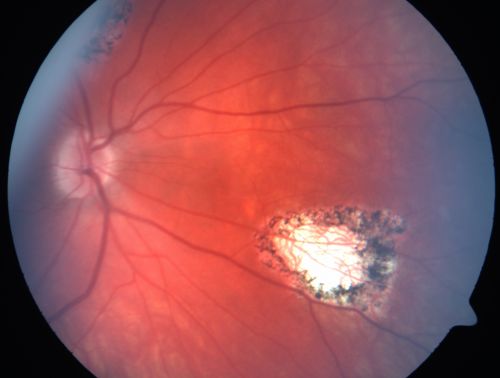 Giant Retinal Diaylsis Retinal Detachment - Previous Inflammatory Retinitis - Small Inferior Retinal Holes
25-year-old man vision loss for three days.  He had a previous episode in this eye in 3 years ago with a strange sort of inflammatory lesion.  He had laser in that eye and a pneumatic retinopexy at the time for a retinal detachment. That same area has a giant dialysis retinal detachment.   OD 20/400, OS is 20/20
