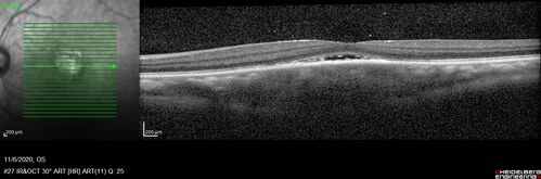 Granulomatous Uveitis - Probable Sarcoid
28 year old white man with red-itch eyes and decreased vision for 3 months. 
VA OD: 3/200 OS: 20/20 
Right eye: granulomatous KP, trace cell, posterior synechiae and iris nodule, 
Left eye: cicatricial upper lid changes, eye is quiet
