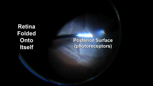 Giant Retinal Tear Retinal Detachment
13 year old african american girl high myope.  These intra-operative photos show parts of the procedure for this giant tear detachment.  The video is on youtube.  You can see the center of the macula with no overlying retina.

