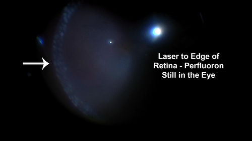 Giant Retinal Tear Retinal Detachment
13 year old african american girl high myope.  These intra-operative photos show parts of the procedure for this giant tear detachment.  The video is on youtube.  You can see the center of the macula with no overlying retina.
