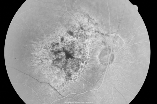 Pistol to head in attempted suicide 3 Months Ago - Retinal Atrophy - Shockwave Retinopathy VA Right Eye - Light Perception - Left Eye - 20/400
66-year-old woman had a gunshot wound to the head on August 12, 2010, with the entry wound just on the right side, just about below her temple, toward the lower part of the temple and the exit wound on the left side just above her cheek, a little behind the eye.  Since then she recovered and did not need any surgery.  When that all cleared she realized her vision was poor in both eyes.  She has seen a neuro-ophthalmologist who thought she had traumatic optic neuropathy.   OD light perception, OS 20/400. 
