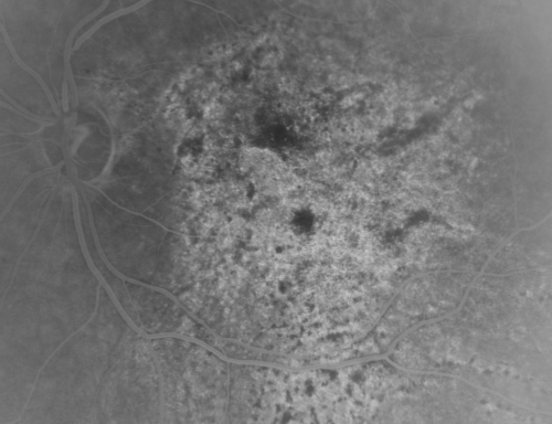 Pistol to head in attempted suicide 3 Months Ago - Retinal Atrophy - Shockwave Retinopathy VA Right Eye - Light Perception - Left Eye - 20/400
66-year-old woman had a gunshot wound to the head on August 12, 2010, with the entry wound just on the right side, just about below her temple, toward the lower part of the temple and the exit wound on the left side just above her cheek, a little behind the eye.  Since then she recovered and did not need any surgery.  When that all cleared she realized her vision was poor in both eyes.  She has seen a neuro-ophthalmologist who thought she had traumatic optic neuropathy.   OD light perception, OS 20/400. 
