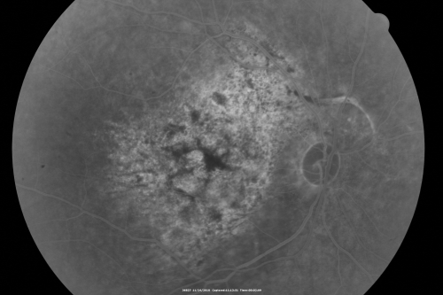 Pistol to head in attempted suicide 3 Months Ago - Retinal Atrophy - Shockwave Retinopathy VA Right Eye - Light Perception - Left Eye - 20/400
66-year-old woman had a gunshot wound to the head on August 12, 2010, with the entry wound just on the right side, just about below her temple, toward the lower part of the temple and the exit wound on the left side just above her cheek, a little behind the eye.  Since then she recovered and did not need any surgery.  When that all cleared she realized her vision was poor in both eyes.  She has seen a neuro-ophthalmologist who thought she had traumatic optic neuropathy.   OD light perception, OS 20/400. 
