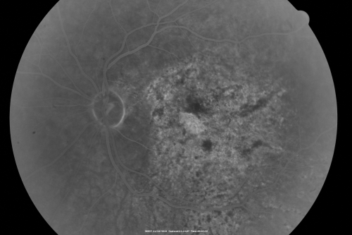 Pistol to head in attempted suicide 3 Months Ago - Retinal Atrophy - Shockwave Retinopathy VA Right Eye - Light Perception - Left Eye - 20/400
66-year-old woman had a gunshot wound to the head on August 12, 2010, with the entry wound just on the right side, just about below her temple, toward the lower part of the temple and the exit wound on the left side just above her cheek, a little behind the eye.  Since then she recovered and did not need any surgery.  When that all cleared she realized her vision was poor in both eyes.  She has seen a neuro-ophthalmologist who thought she had traumatic optic neuropathy.   OD light perception, OS 20/400. 
