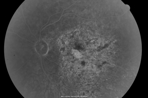 Pistol to head in attempted suicide 3 Months Ago - Retinal Atrophy - Shockwave Retinopathy VA Right Eye - Light Perception - Left Eye - 20/400
66-year-old woman had a gunshot wound to the head on August 12, 2010, with the entry wound just on the right side, just about below her temple, toward the lower part of the temple and the exit wound on the left side just above her cheek, a little behind the eye.  Since then she recovered and did not need any surgery.  When that all cleared she realized her vision was poor in both eyes.  She has seen a neuro-ophthalmologist who thought she had traumatic optic neuropathy.   OD light perception, OS 20/400. 
