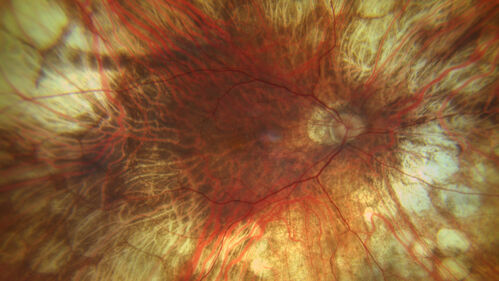 Gyrate atrophy vs Myopic Degeneration
73 year old female with VA 20/16 OD 20/32 OS.  Has cnvm in the left eye.  Genetic testing for gyrate atrophy was negative.
