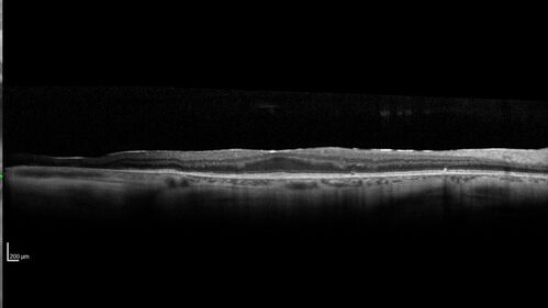 Gyrate atrophy vs Myopic Degeneration
73 year old female with VA 20/16 OD 20/32 OS.  Has cnvm in the left eye.  Genetic testing for gyrate atrophy was negative.
