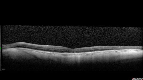 Gyrate atrophy vs Myopic Degeneration
73 year old female with VA 20/16 OD 20/32 OS.  Has cnvm in the left eye.  Genetic testing for gyrate atrophy was negative.
