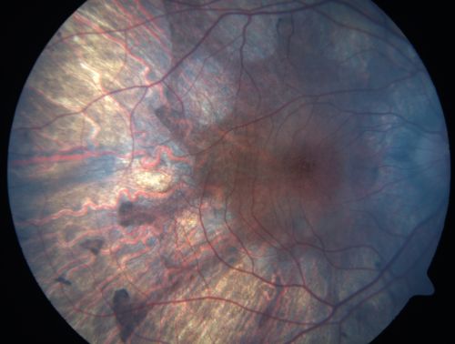Gyrate Atrophy - 15 year old male - 20/25 vision both eyes - Positive Family History
15 year old male was diagnosed with â€œretinitis pigmentosaâ€ at age seven.  The patient reports that his night vision is poor.  He reports he does not notice a visual field change.  He reports that his maternal grandfather has lost vision and a cousin has lost vision as well.  He reports he has an uncle with some visual changes.
The most significantly affected relative is a 26-year-old legally blind cousin.
 20/25+ OD, 20/25 OS. 

